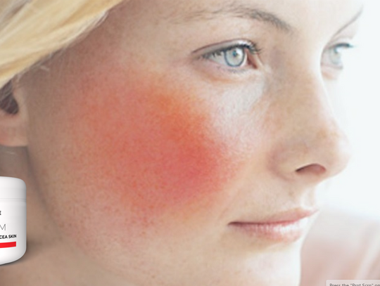 Maść na trądzik różowaty - jaka najlepsza?