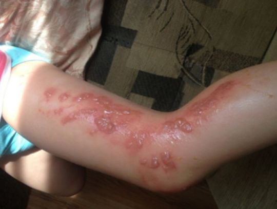 Pierwsze poparzenia w gm. Gniew Uwaga na Barszcz Sosnowskiego