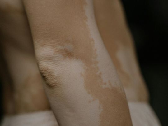 Rewolucyjne metody usuwania przebarwień: Jak urządzenie StarWalker odmienia Twoją skórę?