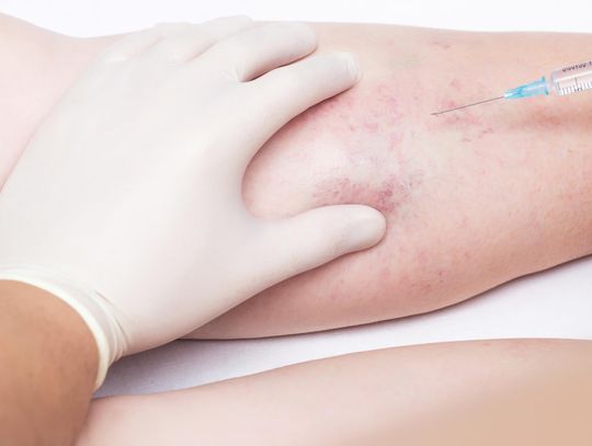 Skleroterapia Łódź na czym polega?