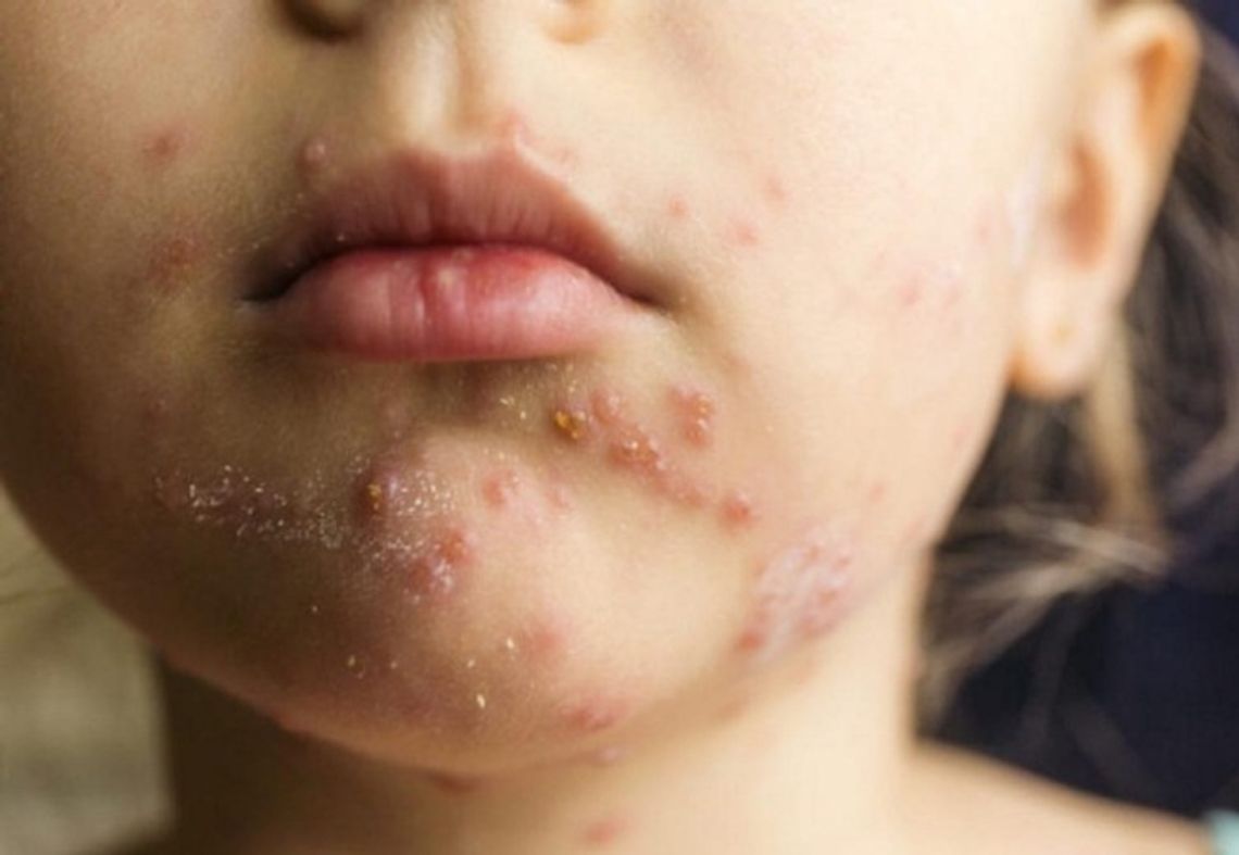 Stwierdzono pierwszy przypadek odry w Starogardzie Gd. Groźna choroba coraz bliżej Tczewa Stwierdzono pierwszy przypadek odry w Starogardzie Gd. Groźna choroba coraz bliżej Tczewa